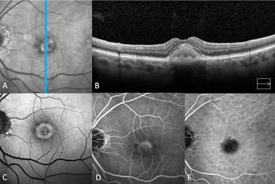 Adult-onset foveomacular vitelliform dystrophy: epidemiology, pathophysiology, imaging, and prognosis